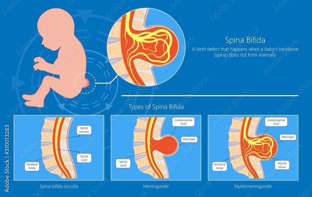 Spina bifida birth defects infant disease Stock Vector | Adobe Stock