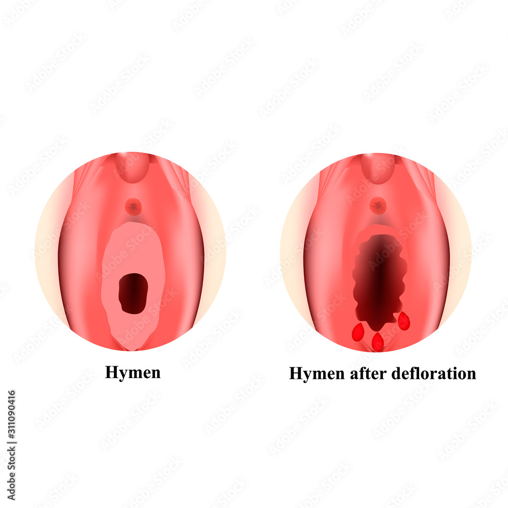 defloratin The structure of the vulva hymen. Hymenoplasty. Hymen after defloration.  Female genital organs. Infographics. Vector illustration on isolated  background. の Stock ベクター | Adobe Stock