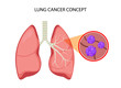 © kolonko - Lung cancer vector concept repiratory disease. Cartoon human lung cancer icon