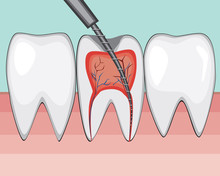 A Treatment Of Molar Pulpitis In A Dental Or Orthodontic Clinic By A Doctor, A Flat Vector Stock Illustration With Open Tooth Channel, Boron Machine And Nerves As A Concept Of Dental Treatment
