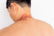 © Nutlegal - Handsome man get allergy of something that make his skin get wound, swell up, red rash. Asian guy get venom of some animals or Paederus dermatitis, Rove beetles bite him. He has a burning pain at skin
