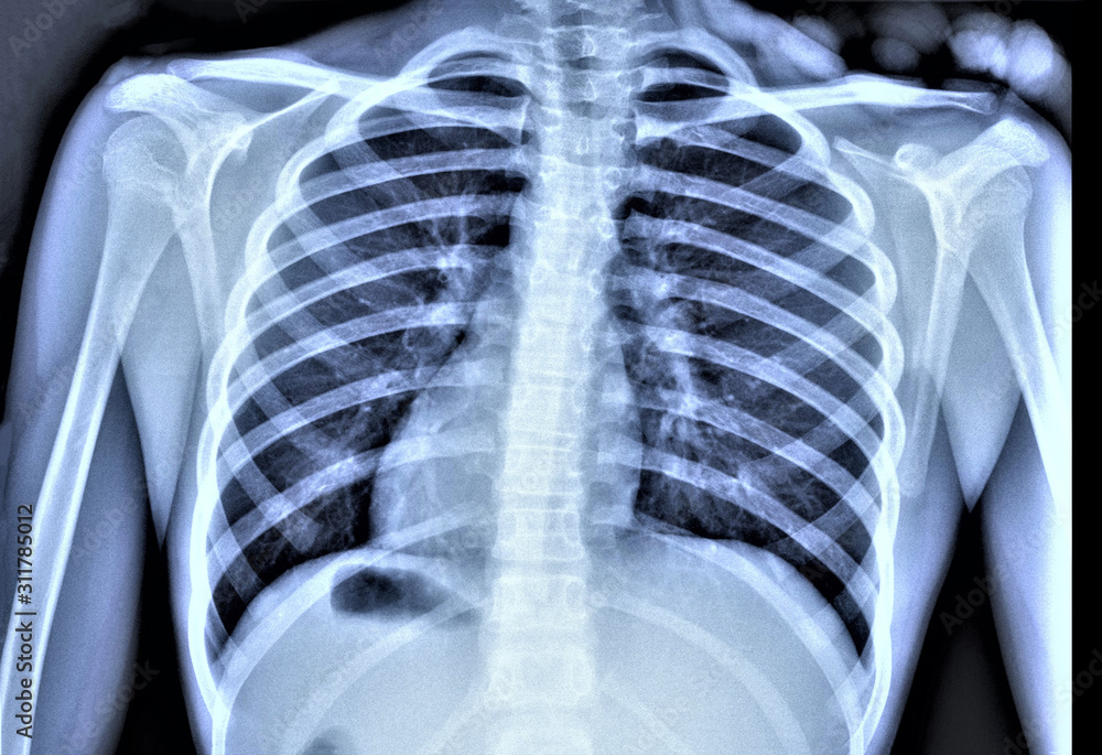 normal radiography of chest organs in direct projection, traumatology ...
