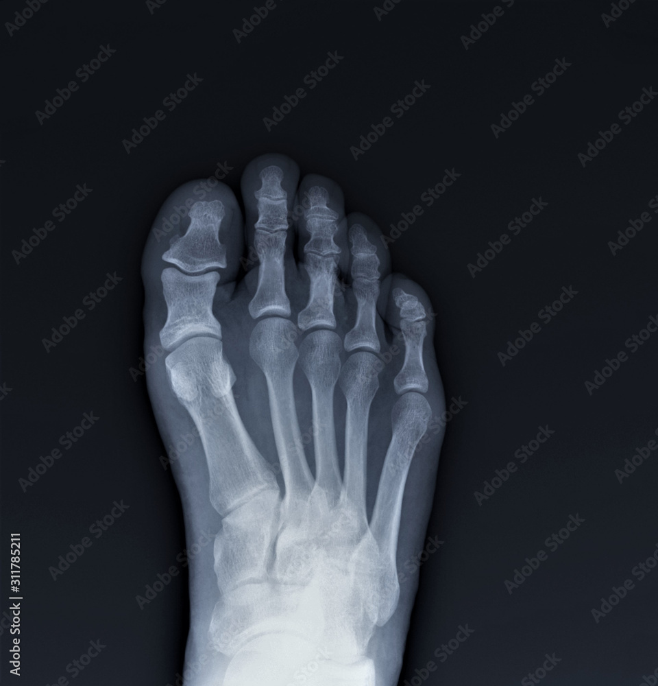 normal radiography of the foot, medical diagnostics, Traumatology and ...
