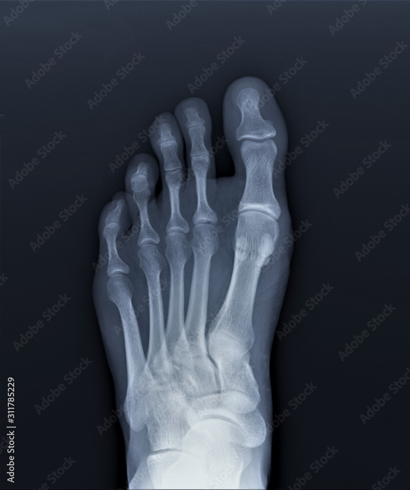 normal radiography of the foot, medical diagnostics, Traumatology and ...