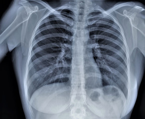 Naklejka na meble normal radiography of chest organs in direct projection, traumatology and orthopedics, pulmonology