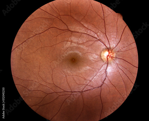 Cuadros en Lienzo Medical photo retina of diabetic - exudate