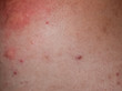 © eleonimages - Allergy skin back and sides. Allergic reactions on the skin in the form of swelling and redness