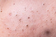 Ugly pimples blackheads on face of teenager