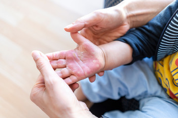 Burned hand of small child