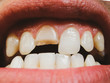 Broken tooth. Broken upper incisor in a man mouth.