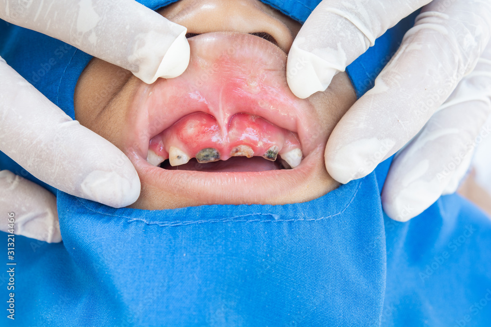 .Mouth ulcers, pain from ulcers. Burning sensation in the mouth and bad ...