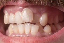 Close-up Of Very Crooked Teeth In An Adult Bearded Guy. Not The Right Bite. Not Healthy Teeth. Violation Of The Position Of The Teeth In The Jaws