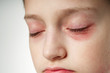© soleg - Allergic reaction, skin rash, close view portrait of a girl's face. Redness and inflammation of the skin in the eyes and lips. Immune system disease.