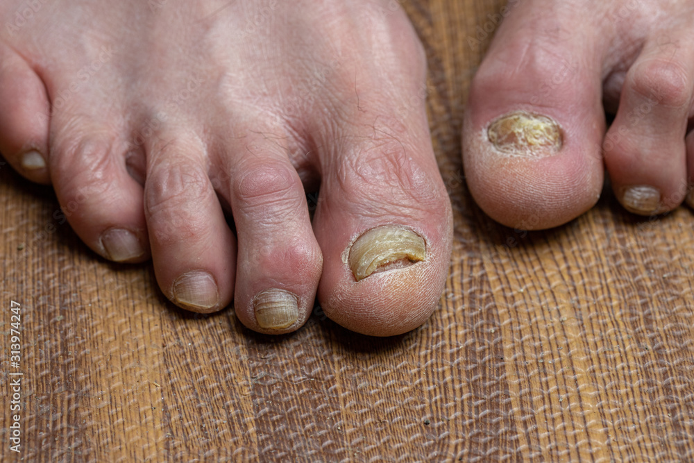 Curled toes on feet of Parkinson's Disease and fungi Stock Photo ...