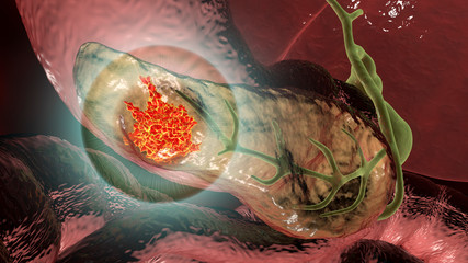 Poster - Pancreatic cancer, malignant tumor of pancreas