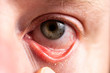Reddened eye with suppuration on eyelashes closeup