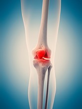 Human Knee Pain, Illustration