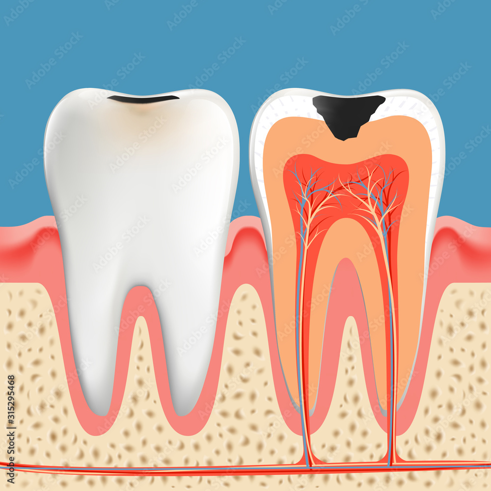 Tooth decay anatomy poster. Enamel and dentin caries Stock Vector ...