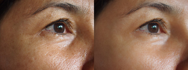 Image before and after treatment rejuvenation surgery on face asian woman concept.Closeup wrinkles dark spots pigmentation on senior female.