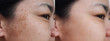 © Duangjan - Closeup asian woman face before and after dark spot melasma pigmentation skin facial treatment.Problem skincare and health concept.