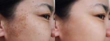 Closeup Asian Woman Face Before And After Dark Spot Melasma Pigmentation Skin Facial Treatment.Problem Skincare And Health Concept.