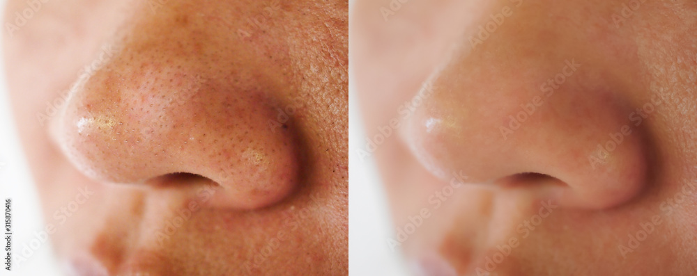 Image closeup before and after treatment small pimple acne blackheads on skin of  nose and spot melasma pigmentation  on facial Asian woman .Problem skincare and health concept. - obrazy, fototapety, plakaty 