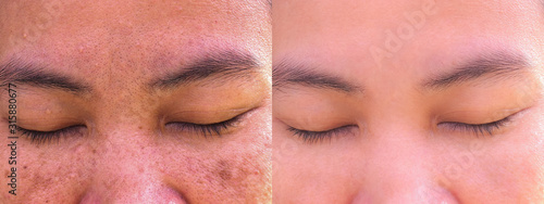 melasma facial