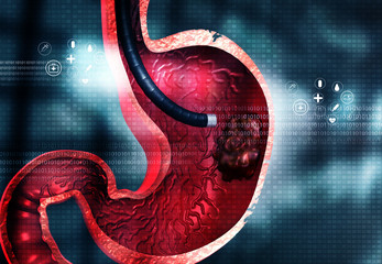 Stomach cancer, Stomach endoscopy. 3d illustration.