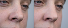 Black Dots, Clogged Pores On The Nose Of A Man Close-up. A Patient At A Beautician Appointment. Before And After Facial Cleansing