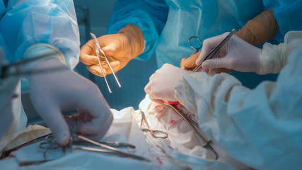 close-up, a team of pediatric surgeons perform surgery for ear lymphadenitis. Oncologists perform a puncture for diagnosis