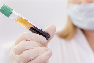 young attractive doctor with mask on face in scrub and gloves holds in hand test tube with separated