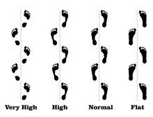 Flatfoot. 4 Footprints Of A Person With Varying Degrees Of Flat Feet.