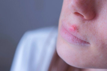 Herpes virus on human lips. Woman with herpes sore on lip mouth, closeup view. Process of dehydration during illness. Human papilloma virus, viral infection.