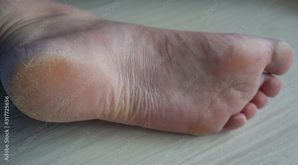 Sole of foot with cracked skin and yellow callus. Wrinkels in the arch ...