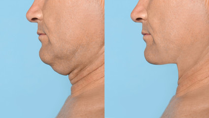 Mature man before and after plastic surgery operation on blue background, closeup. Double chin problem