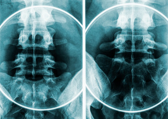 Naklejka na meble X-ray imagery or radiography of human male pelvis and lumbar vertebrae.