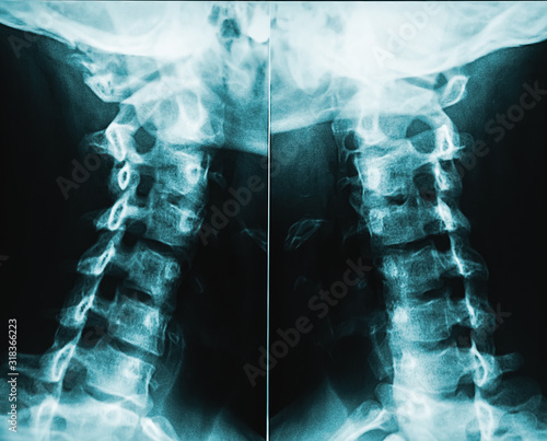 Fotografía X-ray image or radiography of human male neck vertebrae or cervical rachis