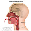 pulmonary aspiration medical vector illustration isolated on white background