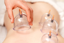 Vacuum Cups Of Medical Cupping Therapy On Woman Back, Close Up, Chinese Medicine.