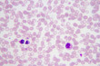 Blood smear with the malaria parasite Plasmodium vivax.