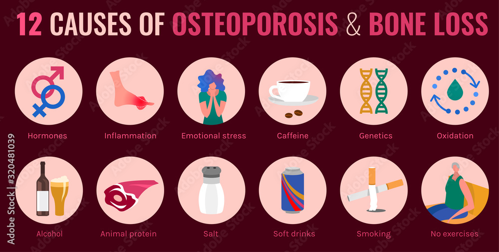 Osteoporosis Infographic Poster - obrazy, fototapety, plakaty 