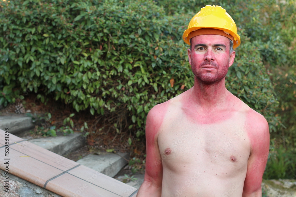 Sunburned construction worker with extreme tan lines - obrazy, fototapety, plakaty 