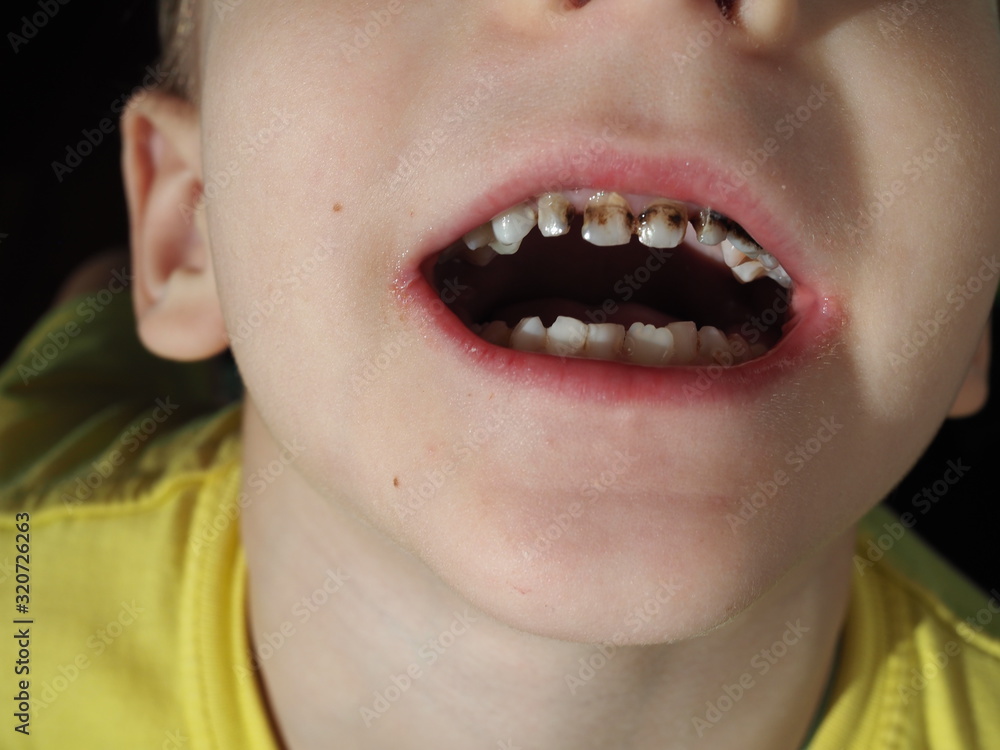 Abnormal boy tooth. The extra narrow strange tooth grew in the boy's ...