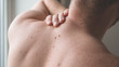 © Анастасія Стягайло - Checking benign moles. Close up detail of the bare skin on a man back with scattered moles and freckles.