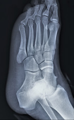 x-ray of the foot with a fracture of the fifth metatarsal bone