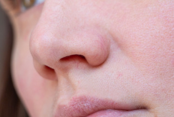 Wall Mural - the girl has red capillaries on her nose