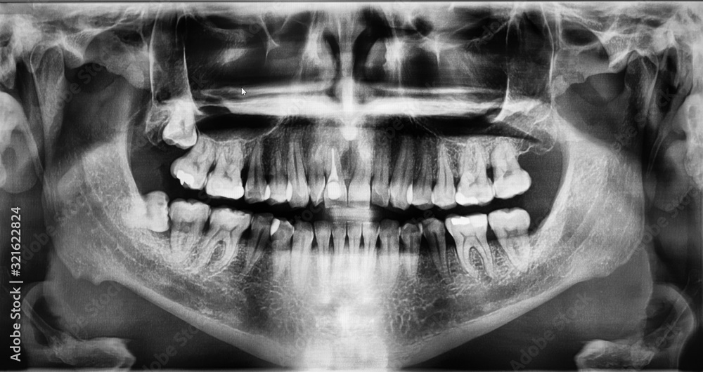 Image tooth x-ray in computer.Panoramic radiograph showed multiple bony ...