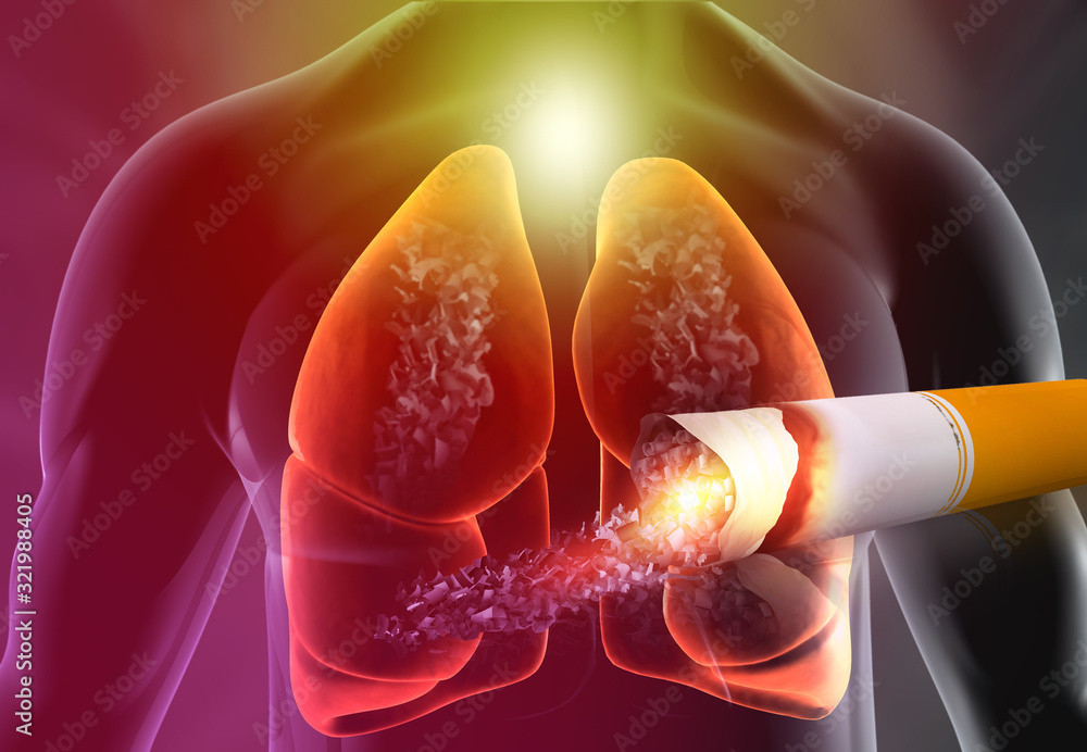 cigarette smoking causes lung cancer Risk Factors and Prevention PET Imaging Human lungs anatomy with cigarette