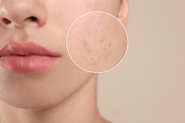 Teenage girl with acne problem on beige background, closeup