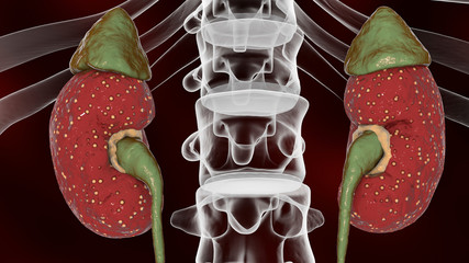 Sticker - Acute pyelonephritis, medical concept